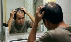 Rambut Rontok, Coba Pakai Bawang Putih Selama 60 Hari Rambut Rontok, Coba Pakai Bawang Putih Selama 60 Hari